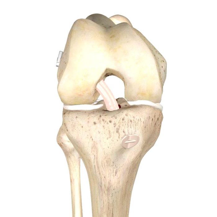 Durable Anterior Cruciate Ligament Ligament Prosthesis Sale Or Rent 