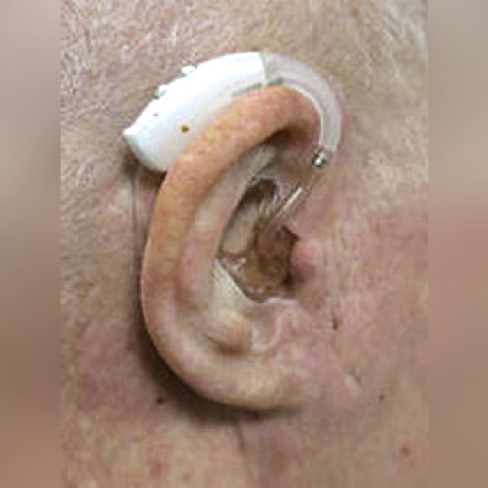 Auricular Cosmetic Prosthesis 2