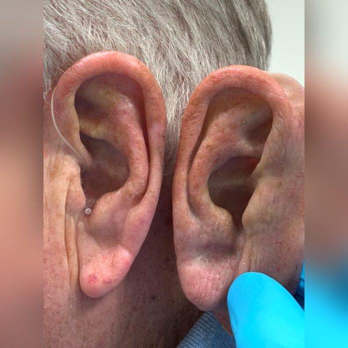 Auricular Cosmetic Prosthesis 3