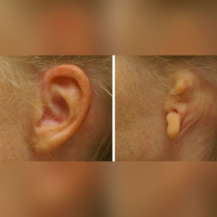 Auricular Cosmetic Prosthesis 5