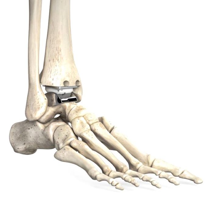 Cementless Ankle Prosthesis 4