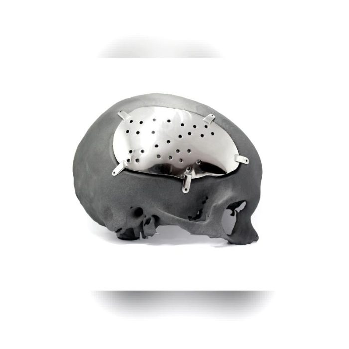 Custom-Made Cranial Implant 1