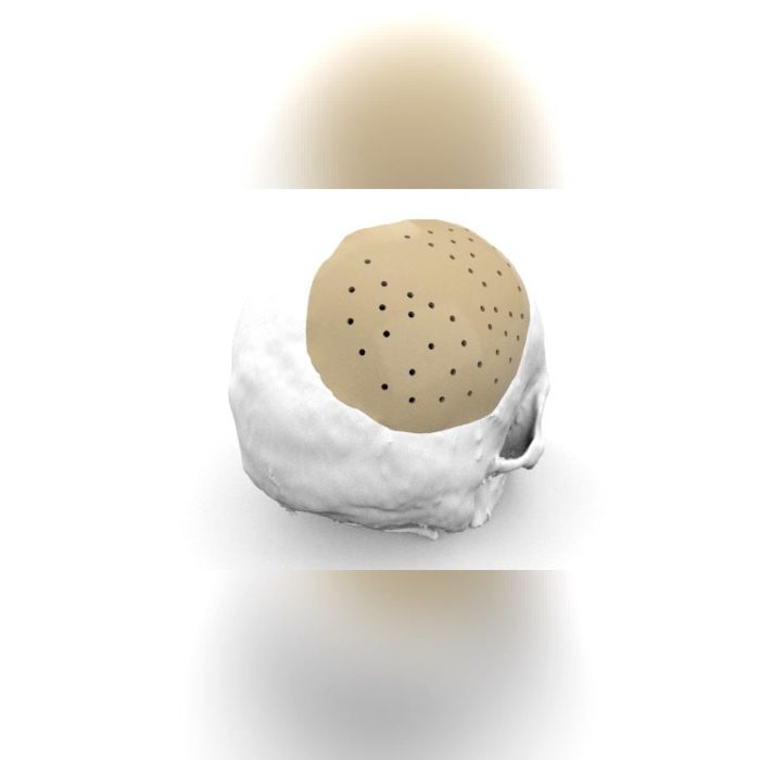 Custom-Made Cranial Implant 2