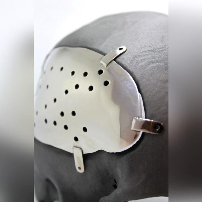 Custom-Made Cranial Implant 4