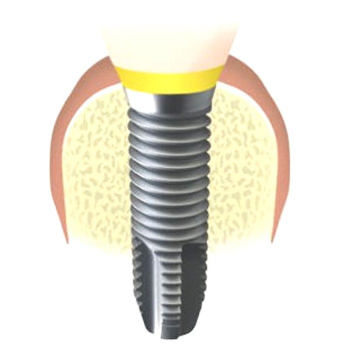 Cylindrical Dental Implant 3