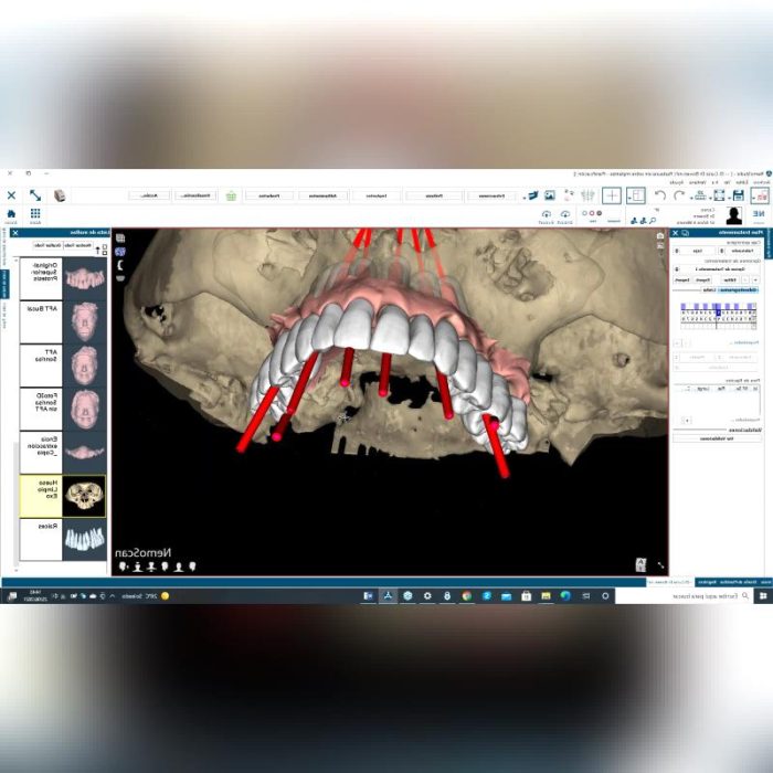 Dental Implantology Software 3