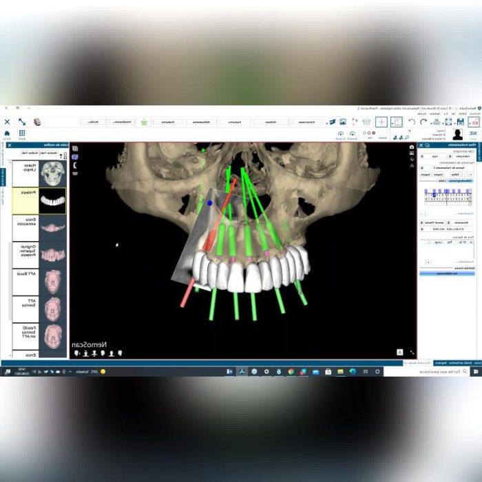 Dental Implantology Software