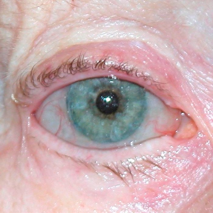Eye Cosmetic Prosthesis 1