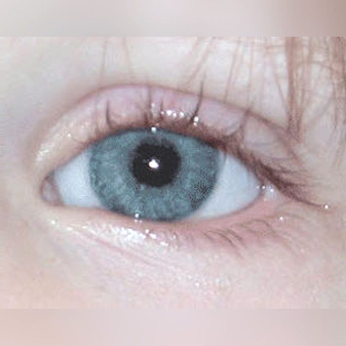 Eye Cosmetic Prosthesis 2