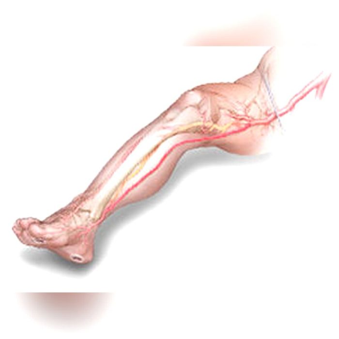 Femoral Artery Vascular Bioprosthesis 2