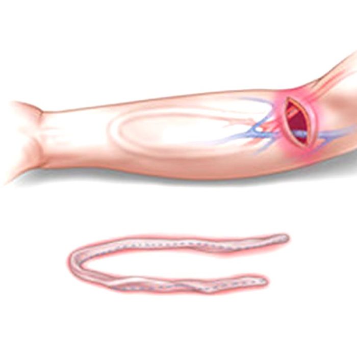 Femoral Artery Vascular Bioprosthesis 3