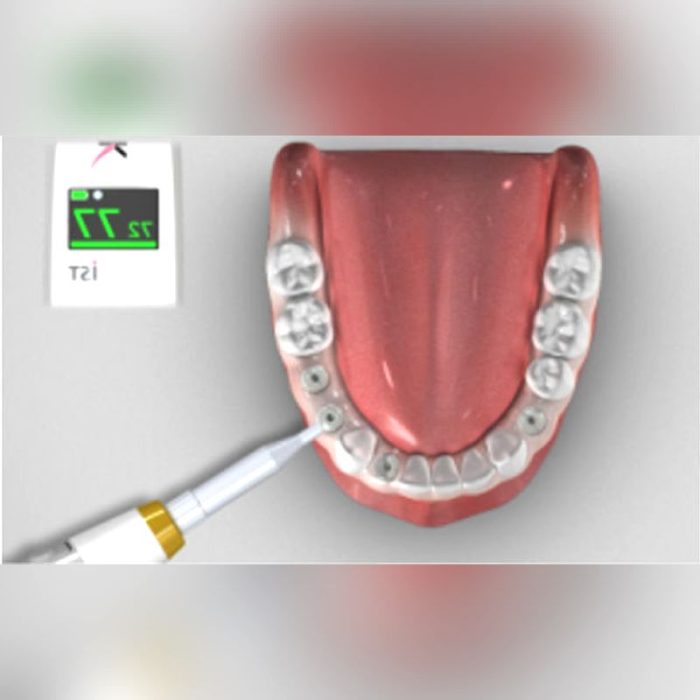 Hand-Held Implant Stability Meter 4