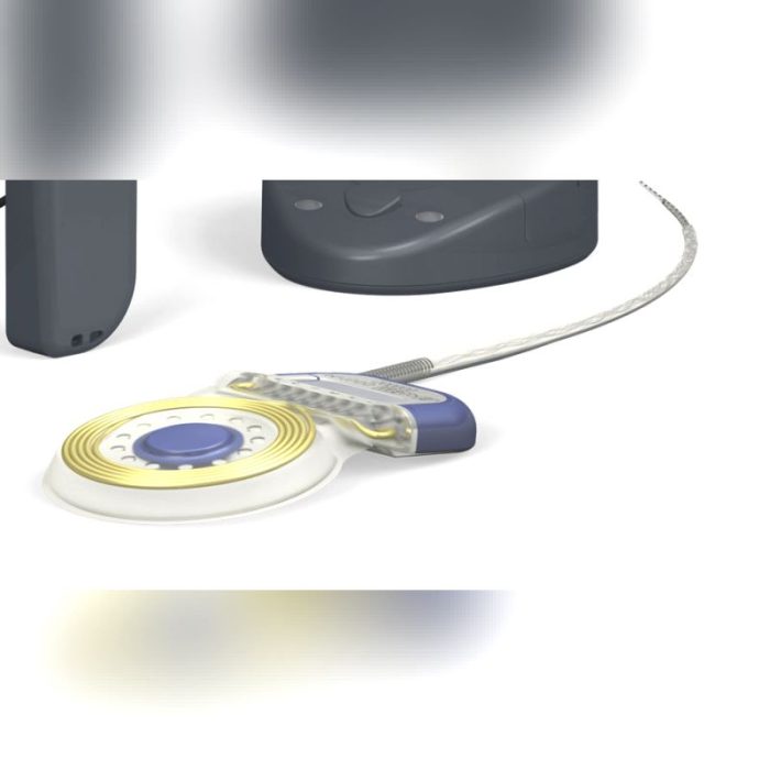 Internal Component Cochlear Implant 3