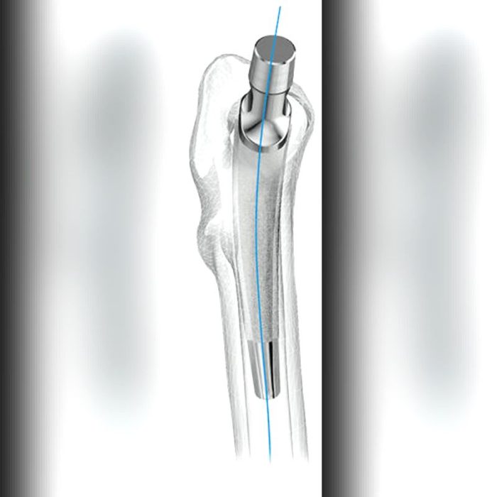 Minimally Invasive Hip Prosthesis 1