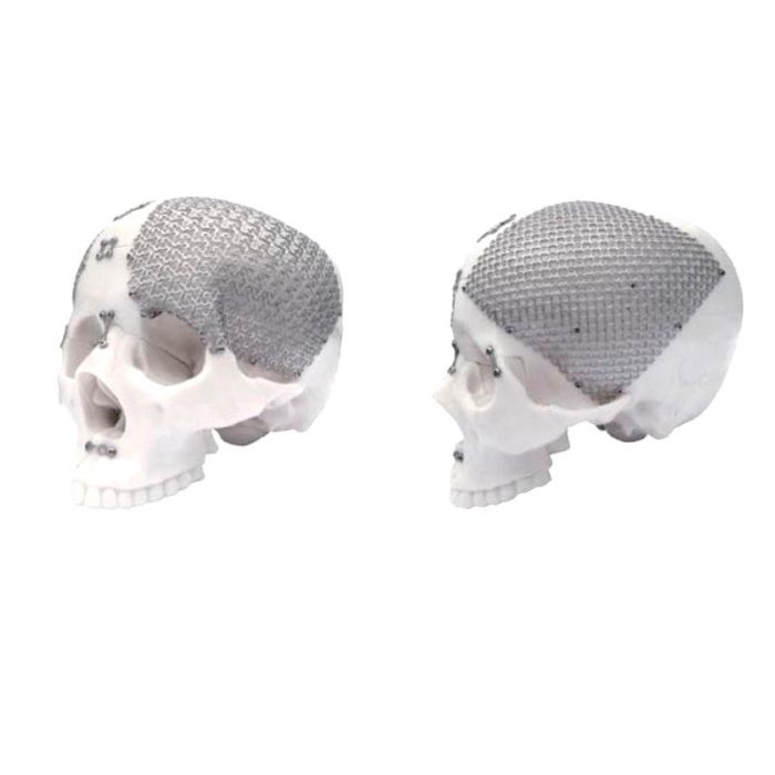 Non-Absorbable Cranial Fixation System