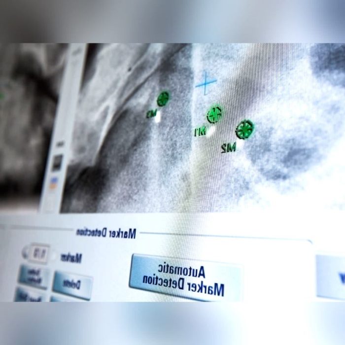 Radiosurgery Qa System 9