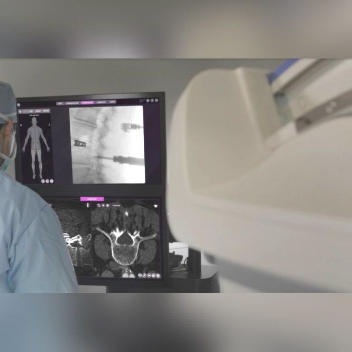 Spine Surgery Surgical Navigation System 2