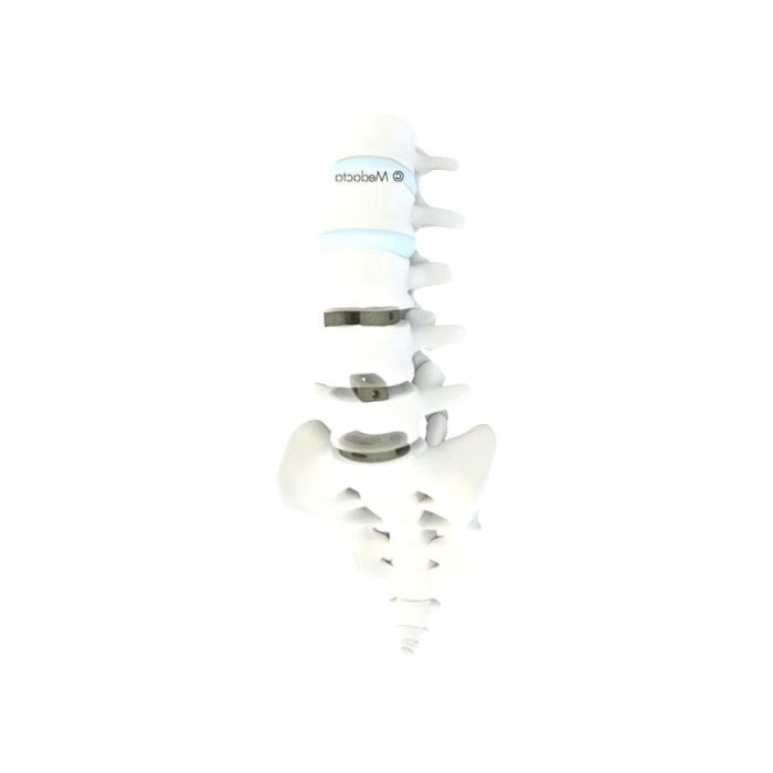Thoraco-Lumbo-Sacral Interbody Fusion Cage 3