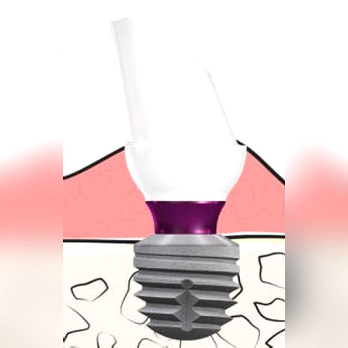 Titanium Implant Abutment 2