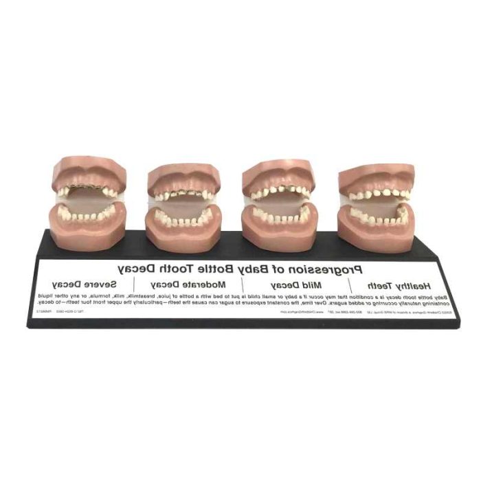 Tooth Decay Anatomical Model
