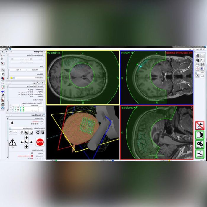 Transcranial Magnetic Stimulator 1