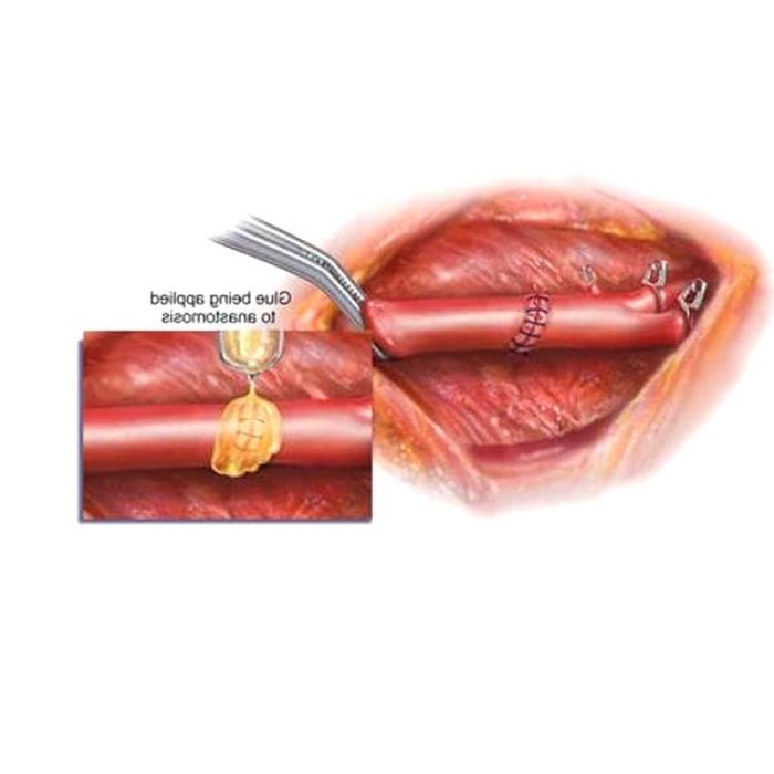 Vascular Surgery Tissue Adhesive 1