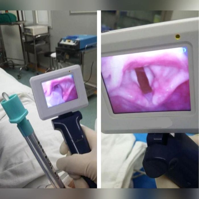Video Laryngoscope 2